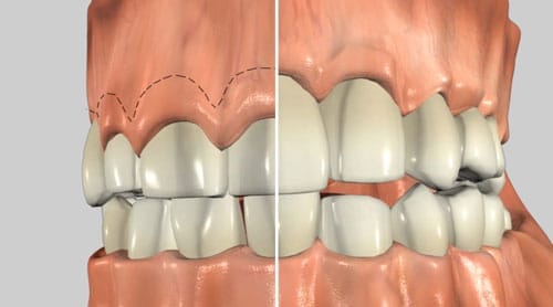An implant being put into mouth