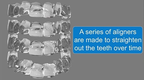 Picture of an invisalign aligner